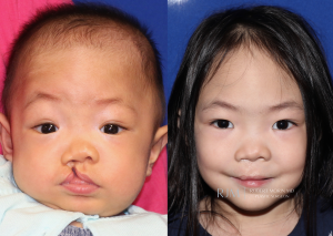  Child face, before and after Cleft Lip Repair treatment, front view - patient 5