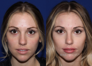  Female face, before and after Lip Augmentation treatment, front view, patient 2