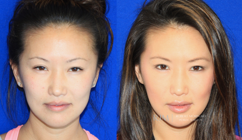  Female face, before and after Lip Augmentation treatment in New Jersey, front view, patient 4