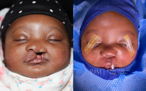  Child face, before and after Cleft Lip Repair treatment, front view, patient 3