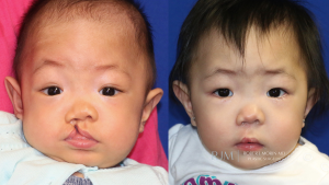  Child face, before and after Cleft Lip Repair treatment, front view, patient 5