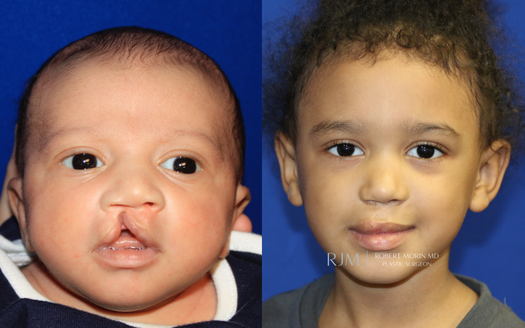  Child face, before and after Cleft Lip Repair treatment, front view, patient 6
