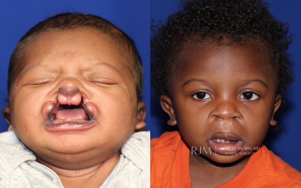  Child face, before and after Cleft Lip Repair treatment, front view, patient 1