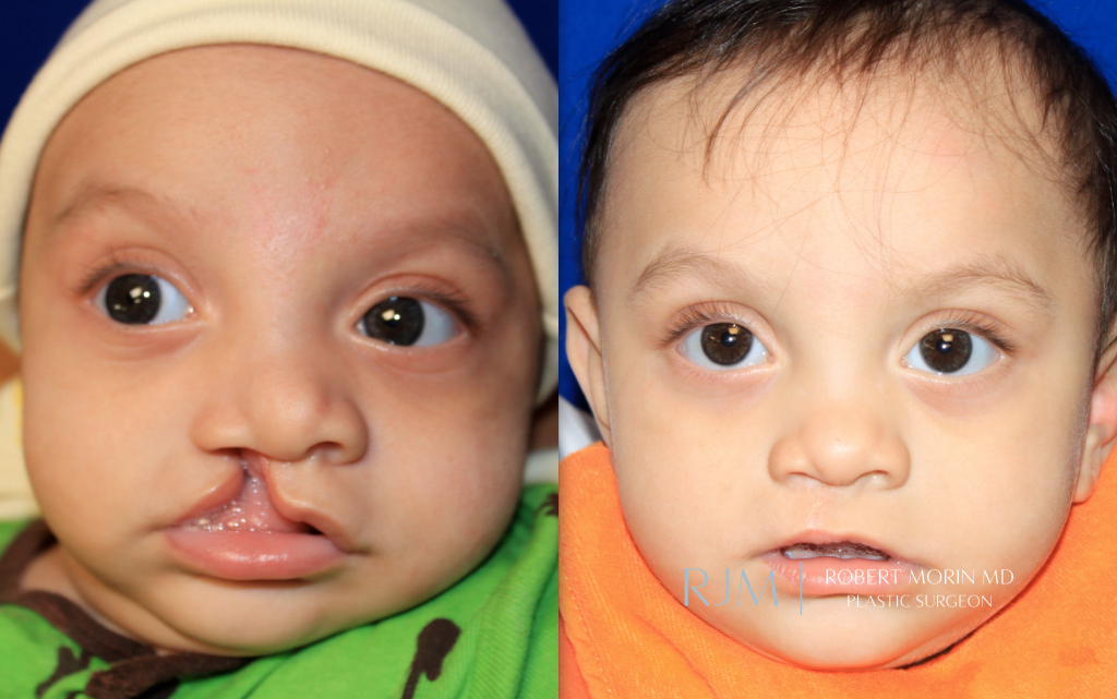  Child face, before and after Cleft Lip Repair treatment, front view, patient 2
