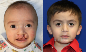  Child face, before and after Cleft Lip Repair treatment, front view - patient 4