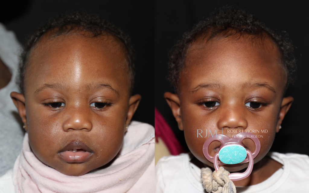  Child face, before and after Cranial Vault Surgery treatment, front view, patient 1
