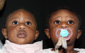  Child face, before and after Cranial Vault Surgery treatment, front view (thrown back), patient 1