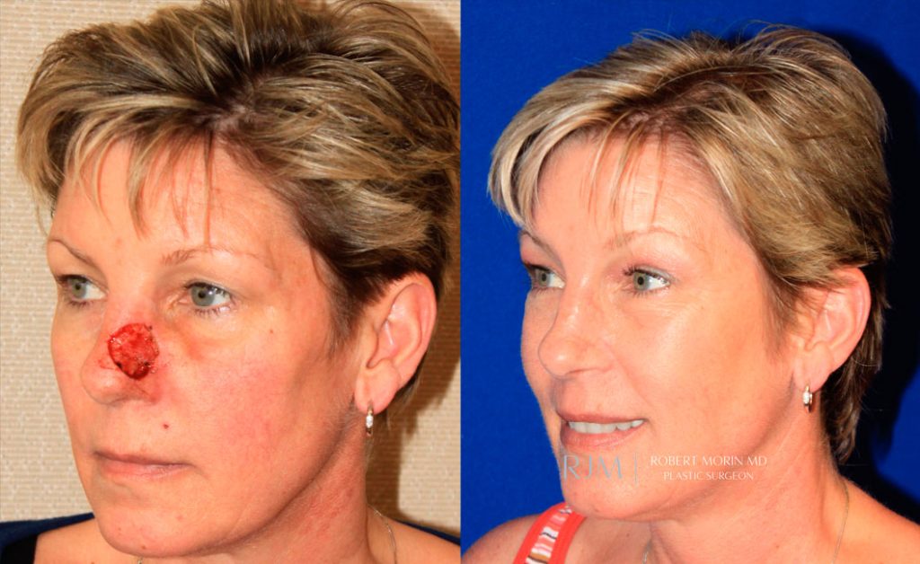  Woman's face, before and after Mohs/Skin Cancer Reconstruction treatment in New Jersey, oblique view, patient 5