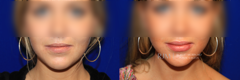  Female face, before and after Lip Augmentation treatment in New Jersey, front view, patient 5