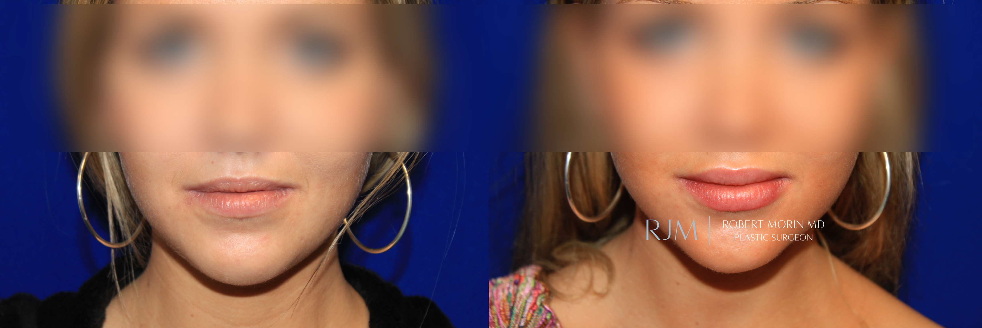  juvederm lips before and after