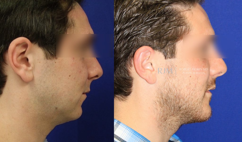  Male face, before and after Genioplasty treatment in New Jersey, side view, patient 2