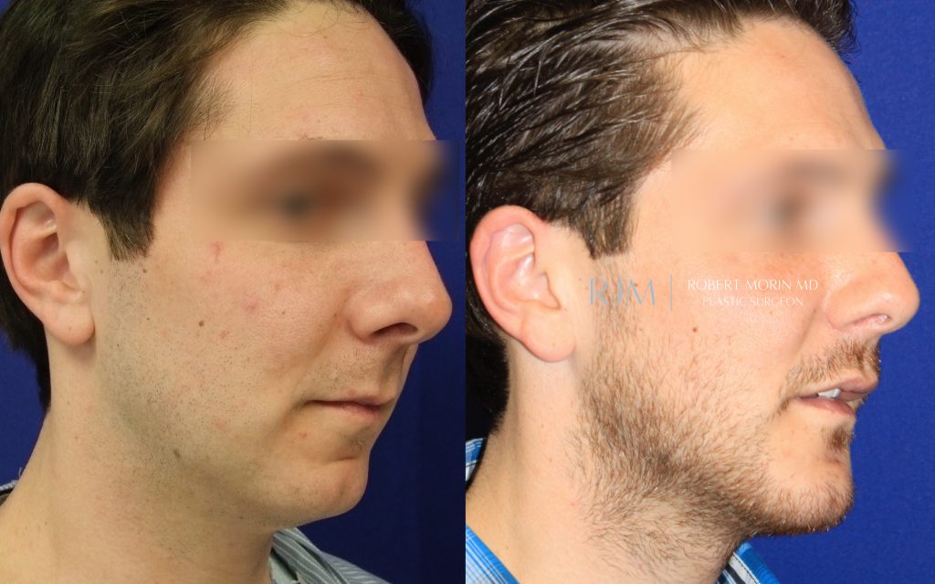  Male face, before and after Genioplasty treatment in New Jersey, oblique view, patient 2