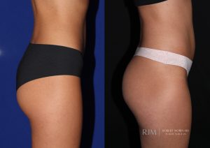  Female body, before and after EmSculpt treatment, r-side view, patient 2
