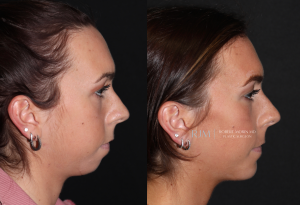  Womans face, before and after Genioplasty treatment in New Jersey, side view, patient 1