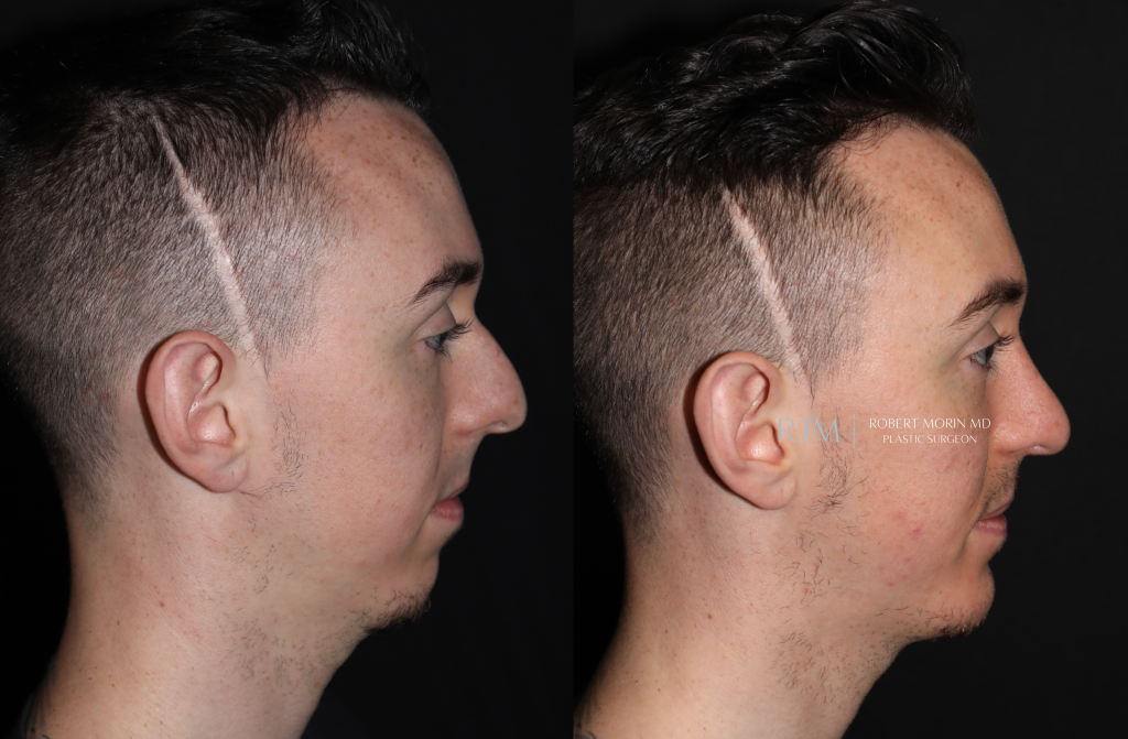  Male face, before and after Genioplasty treatment in New Jersey, side view, patient 6
