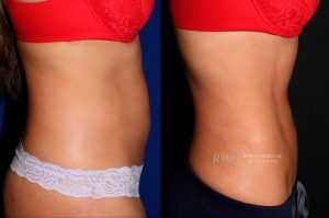  Female body, before and after EmSculpt treatment, r-side view, patient 1
