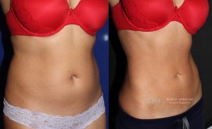  Female body, before and after EmSculpt treatment, oblique view - patient 1
