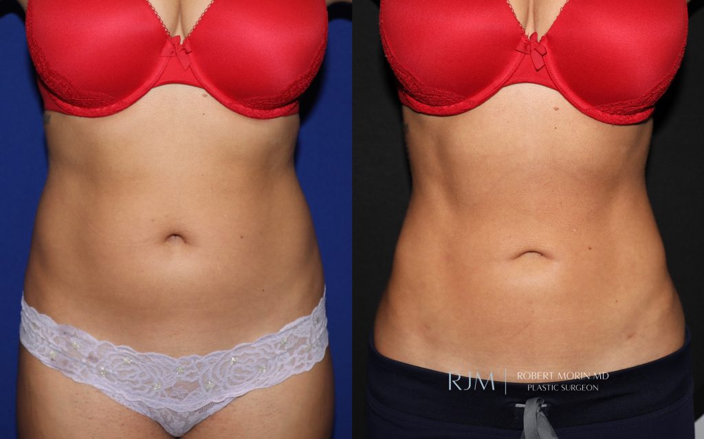  Female body, before and after EmSculpt treatment in New Jersey, front view, patient 1