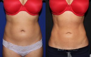  Female body, before and after EmSculpt treatment, front view, patient 1