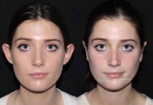  Female face, before and after Ear Reconstruction treatment, front view, patient 3