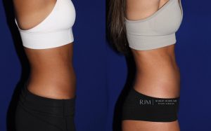  Female body, before and after EmSculpt treatment in New Jersey, r-side view, patient 3