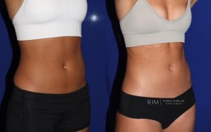  Female body, before and after EmSculpt treatment in New Jersey, oblique view, patient 3