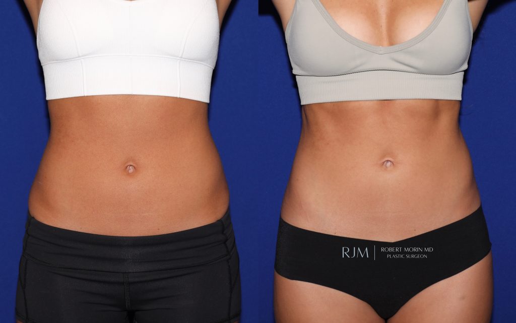  Female body, before and after EmSculpt treatment in New Jersey, front view, patient 3