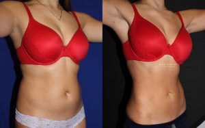  Female body, before and after EmSculpt treatment, oblique view, patient 1