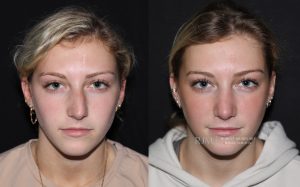  Female face, before and after rhinoplasty treatment, front view - patient 01