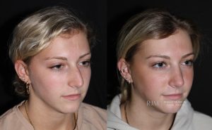 Female face, before and after rhinoplasty treatment, oblique view - patient 01