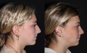  Female face, before and after rhinoplasty treatment, r-side view - patient 01
