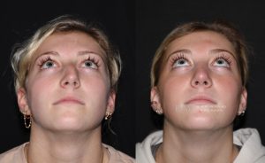  Female face, before and after rhinoplasty treatment, front view (thrown back) patient 01