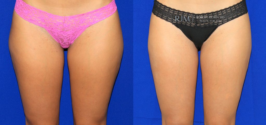  Female body, before and after Liposuction treatment in New Jersey, front view, patient 2
