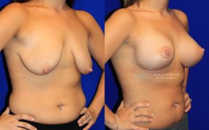  Female body, before and after Breast Lift treatment, oblique view, patient 1