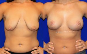  Female body, before and after Breast Lift treatment, front view, patient 1