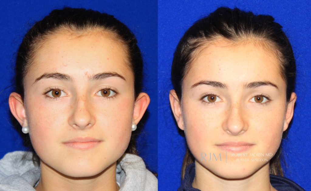  Female face, before and after Otoplasty treatment, front view, patient 2