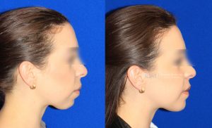  Womans face, before and after Genioplasty treatment in New Jersey, side view, patient 5