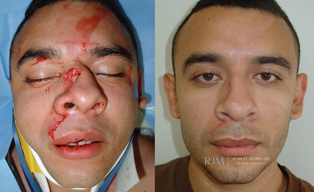  Male face, before and after Nasal Bone Fracture Repair treatment, front view, patient 3