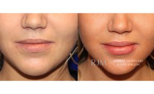  Female face, before and after Lip Augmentation treatment, front view, patient 6