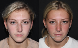  Rhinoplasty before and after