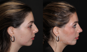  rhinoplasty before and after NJ