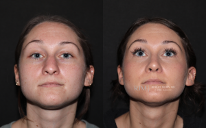  Rhinoplasty before and after NJ