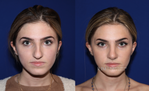  Robert Morin MD before and after rhinoplasty