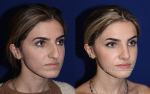  Robert Morin MD before and after rhinoplasty