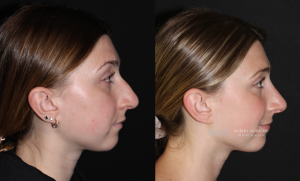  rhinoplasty before and after
