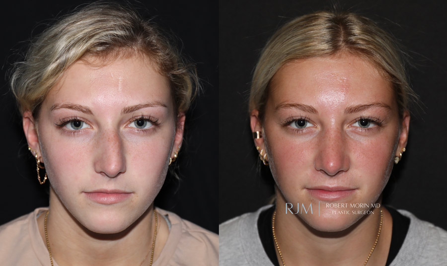 Ultrasonic Rhinoplasty Before & After Photos 1