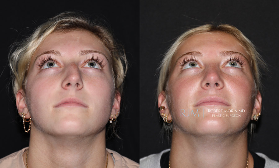 Male face, before and after Rhinoplasty treatment, side view, patient 3
