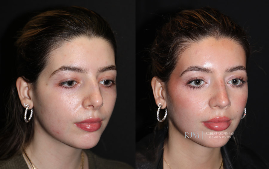 Ultrasonic Rhinoplasty Before & After Photos 11