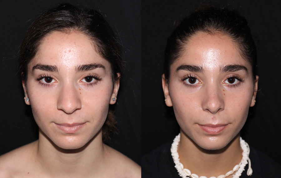 Ultrasonic Rhinoplasty Before & After Photos 12