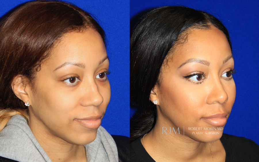 Ultrasonic Rhinoplasty Before & After Photos 13